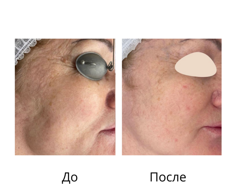 Фотоомоложение - Грушко Дарья