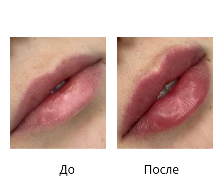 Контурная пластика губ - Грушко Дарья