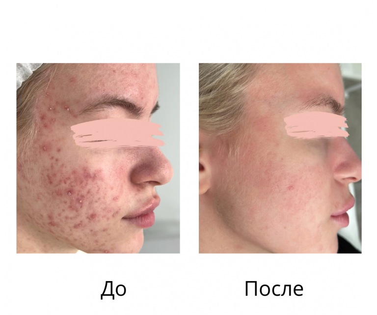 Комплексное лечение акне - Осколкова Анастасия