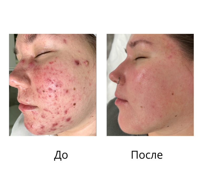 Комплексное лечение акне - Осколкова Анастасия